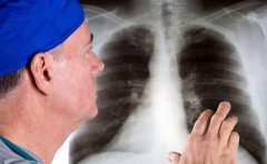 肺癌晚期最怕三个征兆，肺癌晚期临终前1个月症状